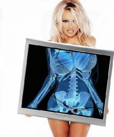 Pamela Anderson X-ray image